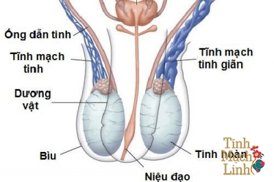Khi nào nên phẫu thuật giãn tĩnh mạch thừng tinh?
