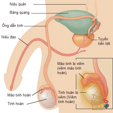 Bệnh sa đì ở nam giới: Nguyên nhân, biểu hiện, cách điều trị