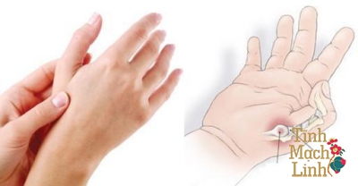 Đau khớp ngón tay cái: Biểu hiện của hội chứng ống cổ tay