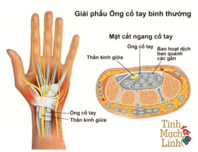 Hội chứng ống cổ tay: Bệnh lý phổ biến của dân văn phòng