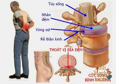 Nhận biết 10 nguyên nhân hàng đầu gây tê bì chân tay