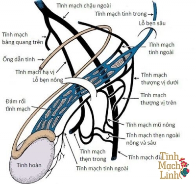 Vì sao phải điều trị giãn tĩnh mạch thừng tinh ngay cả khi không đau không sưng tinh hoàn?