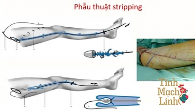 Phẫu thuật trị suy giãn tĩnh mạch nông có ưu và nhược điểm gì?