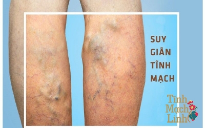 Phân biệt viêm tĩnh mạch nông và suy giãn tĩnh mạch