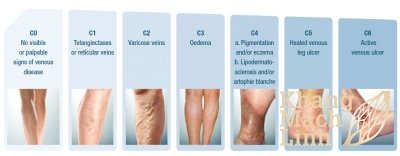 Nhận biết 7 cấp độ của bệnh lý suy giãn tĩnh mạch chân 