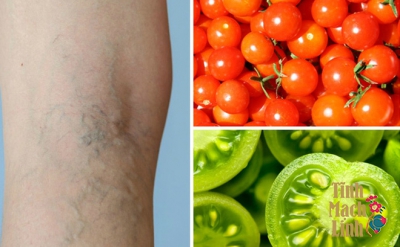 Cà chua và bí quyết đẩy lùi suy giãn tĩnh mạch