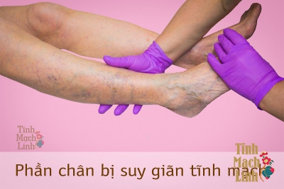 Suy giãn tĩnh mạch chân chẩn đoán và cách điều trị theo Đông Y 