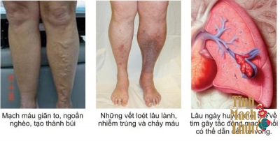 Hỏi đáp: suy giãn tĩnh mạch chân có nguy hiểm không