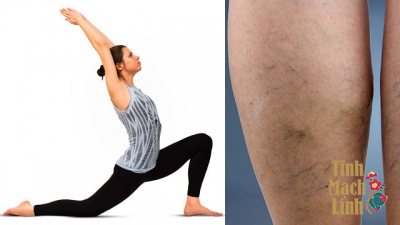 Suy giãn tĩnh mạch có tập yoga được không?