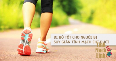 Lợi tích từ việc đi bộ đối với người suy giãn tĩnh mạch chi dưới 
