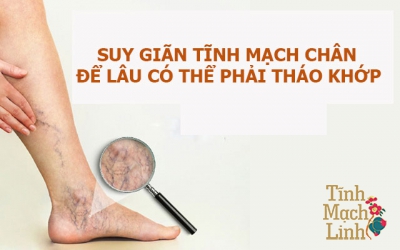 Có thể tháo khớp nếu các tĩnh mạch ngoằn ngoèo ở lâu trên chân