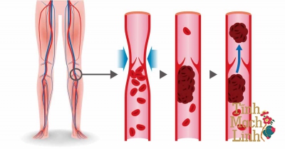 Những nguyên nhân chính gây bệnh suy giãn tĩnh mạch chi dưới