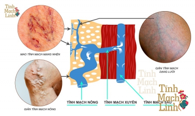 Suy giãn tĩnh mạch nông , phòng và điều trị theo quan điểm Đông Y