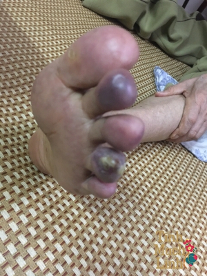 Nguyên nhân, triệu chứng và phương pháp điều trị bệnh lý viêm tắc mạch máu theo Y học cổ truyền