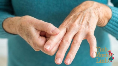 Phòng và điều trị tê chân tê tay theo Y học cổ truyền