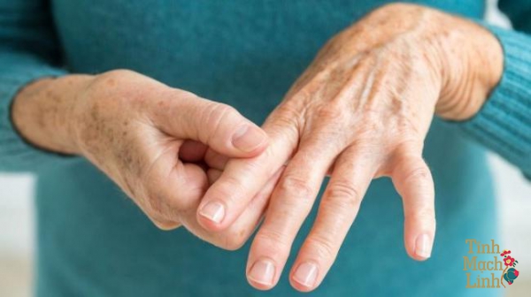 Phòng và điều trị tê chân tê tay theo Y học cổ truyền