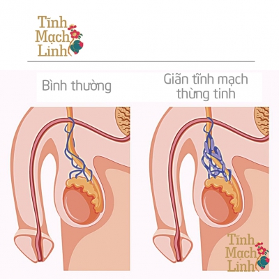 Bí quyết điều trị giãn tĩnh mạch thừng tinh theo quan điểm của Y học cổ truyền