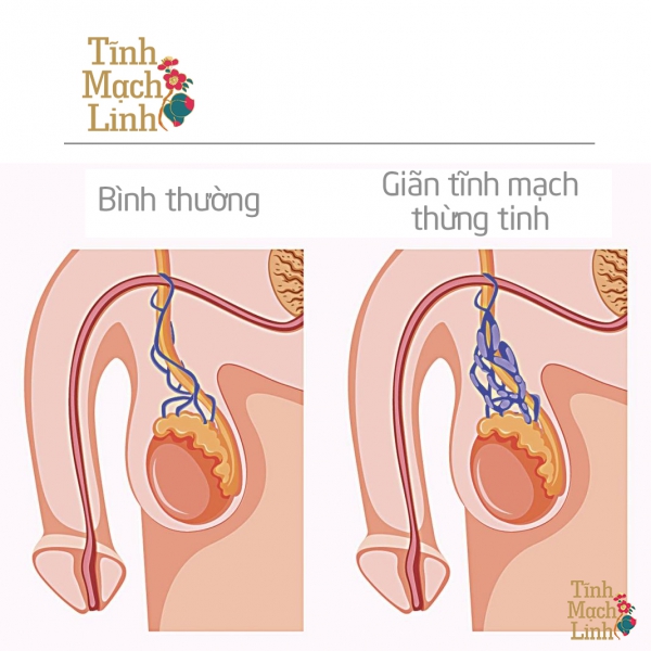 Bí quyết điều trị giãn tĩnh mạch thừng tinh theo quan điểm của Y học cổ truyền