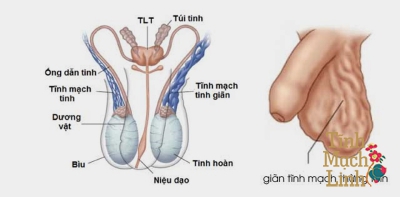 Bệnh nhân mắc giãn tĩnh mạch thừng tinh nên kiêng gì?