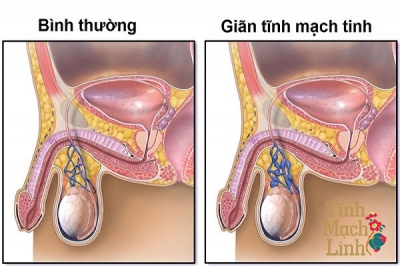 Bị giãn tĩnh mạch thừng tinh có quan hệ tình dục được không?