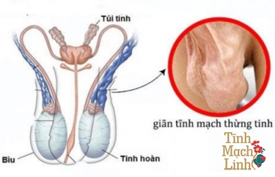 Giãn tĩnh mạch thừng tinh có khả năng có con không?