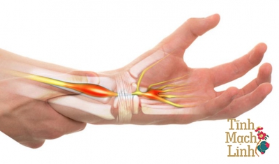 Điều trị hội chứng ống cổ tay theo Y học cổ truyền