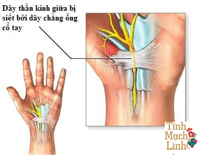 Lưu lại ngay 9 bài tập chữa trị hội chứng ống cổ tay cực dễ